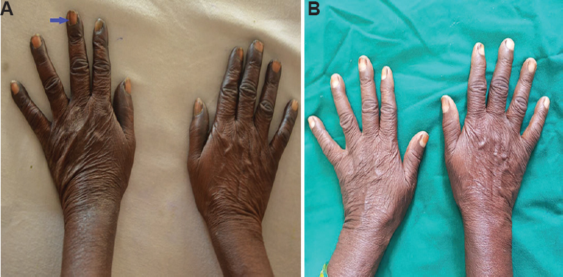 (A) Diffuse hyperpigmentation and longitudinal melanonychia. (B) Reduction in hyperpigmentation and reversal of longitudinal melanocychia at 12 weeks.